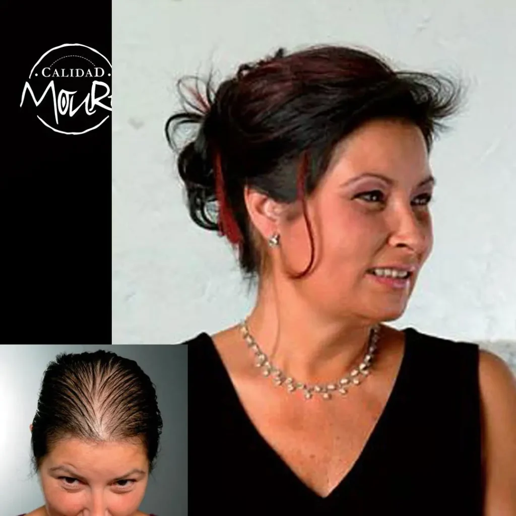 PROTESIS-MALLA-SUIZA-MUJER-MOURE-2