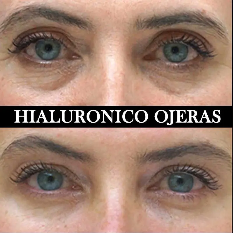 ACIDO-HIALURONICO-ENTRECEJO-NASOJENIANO-OJOS-CENTROS-MOURE-MALLORCA-1