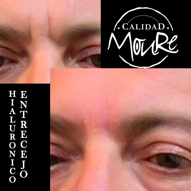 ACIDO-HIALURONICO-ENTRECEJO-NASOJENIANO-OJOS-CENTROS-MOURE-MALLORCA-10