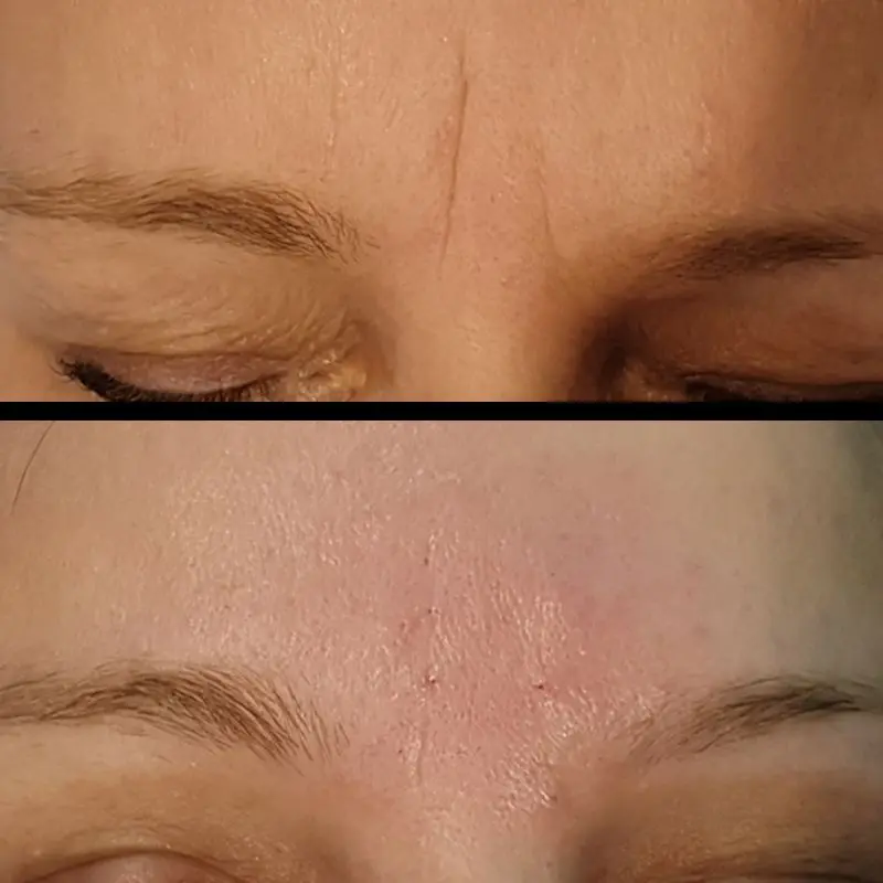 ACIDO-HIALURONICO-ENTRECEJO-NASOJENIANO-OJOS-CENTROS-MOURE-MALLORCA-6
