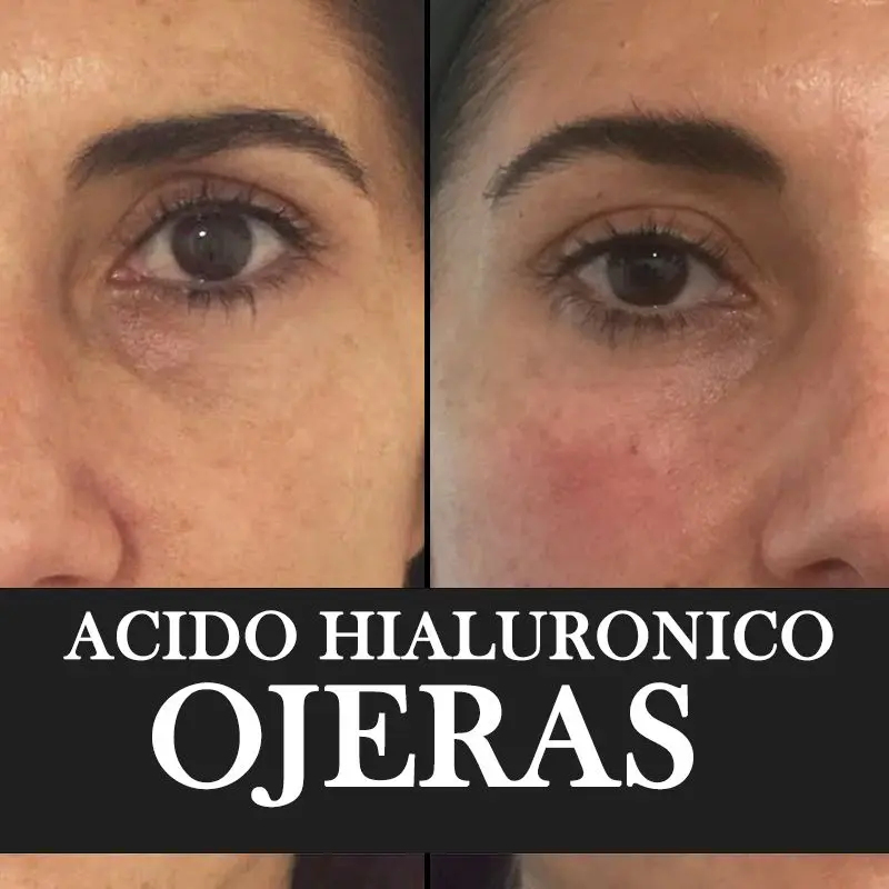ACIDO-HIALURONICO-ENTRECEJO-NASOJENIANO-OJOS-CENTROS-MOURE-MALLORCA-9