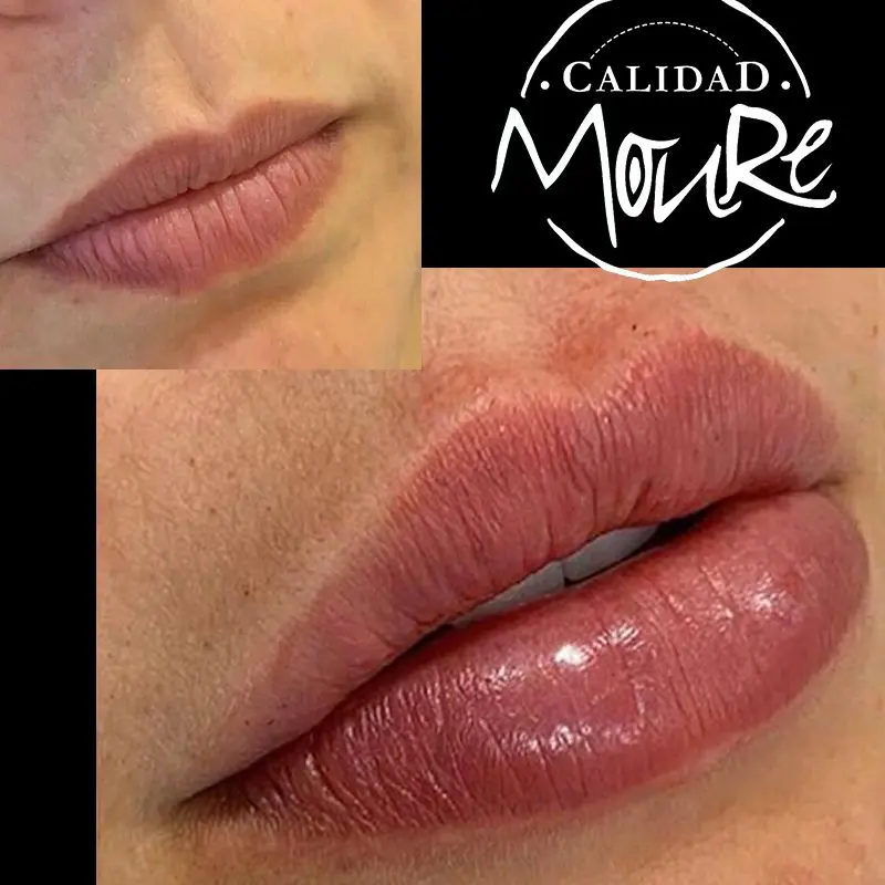 ACIDO-HIALURONICO-HIALUROPEN-CENTRO-DE-ESTETICA-MOURE-MALLORCA-RELLENO-12