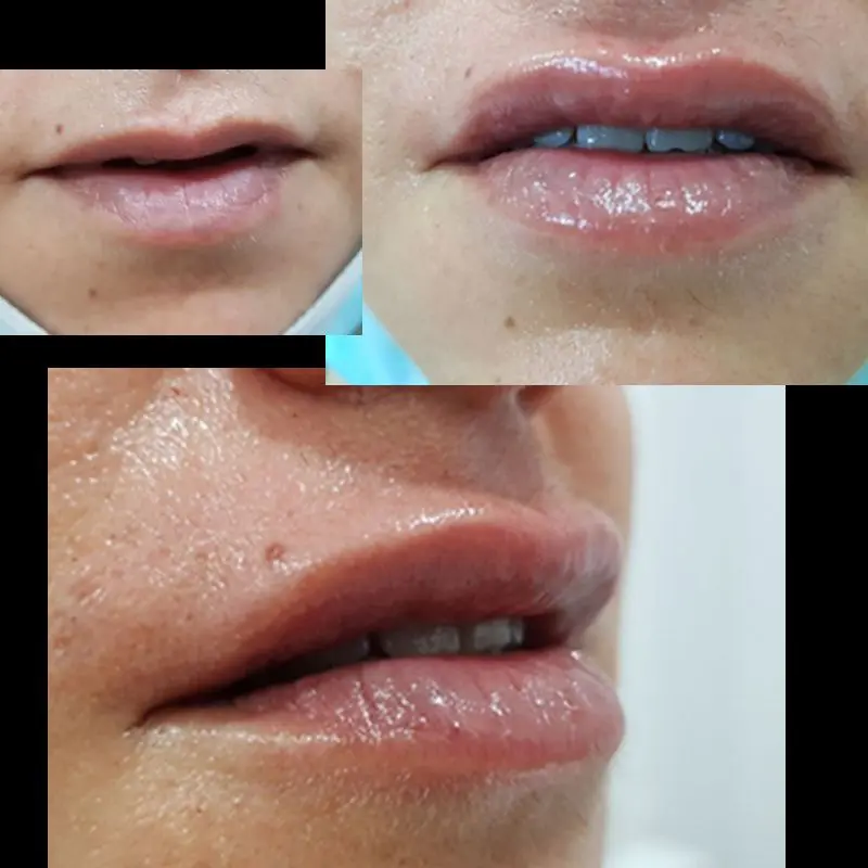 ACIDO-HIALURONICO-HIALUROPEN-CENTRO-DE-ESTETICA-MOURE-MALLORCA-RELLENO-6