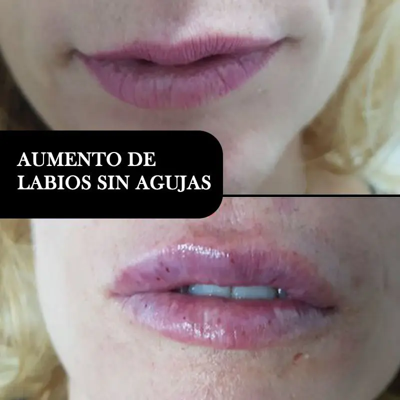 ACIDO-HIALURONICO-HIALUROPEN-CENTRO-DE-ESTETICA-MOURE-MALLORCA-RELLENO-7