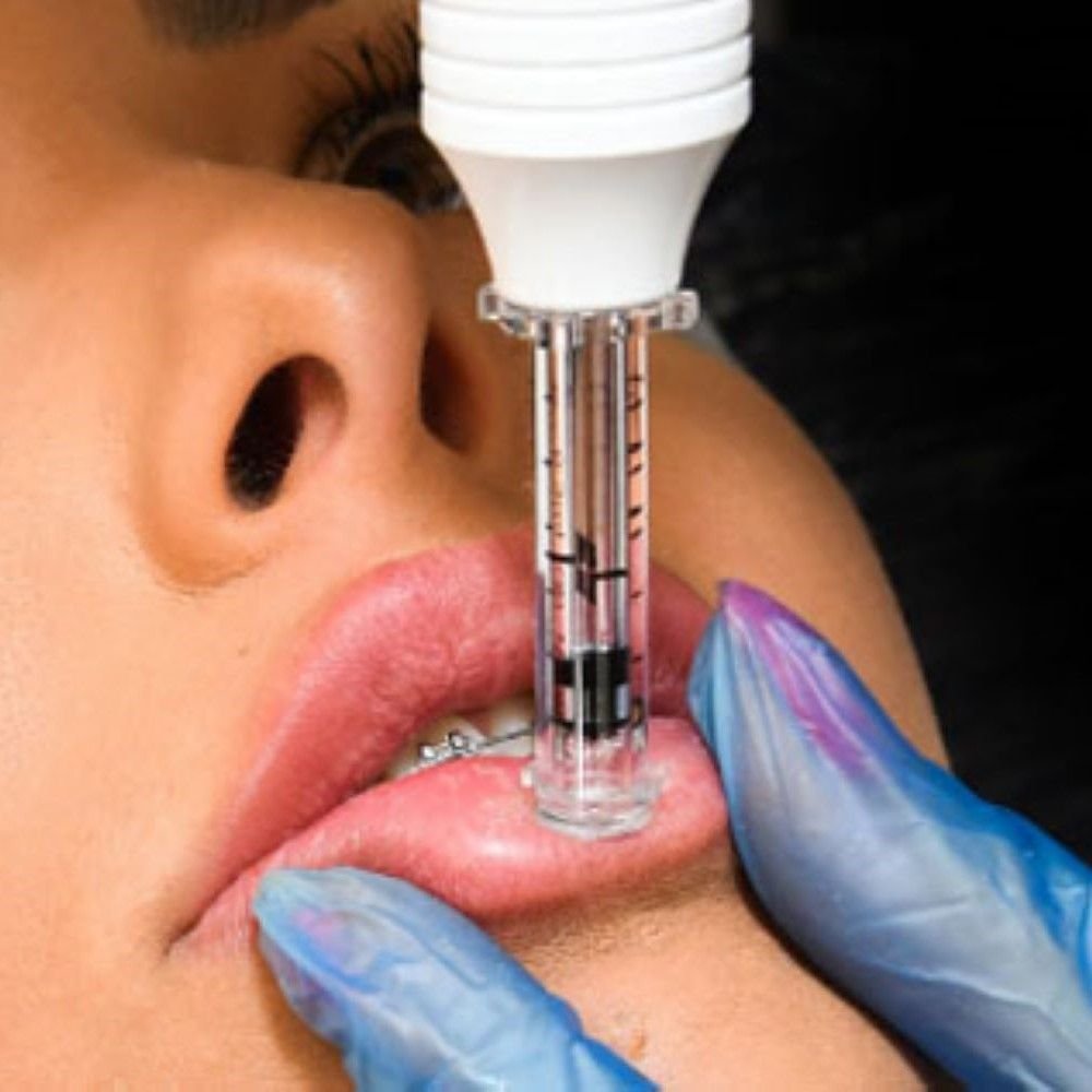 ACIDO-HIALURONICO-LABIOS-HIALUROPEN-PALMA-DE-MALLORCA-CENTROS-MOURE-12