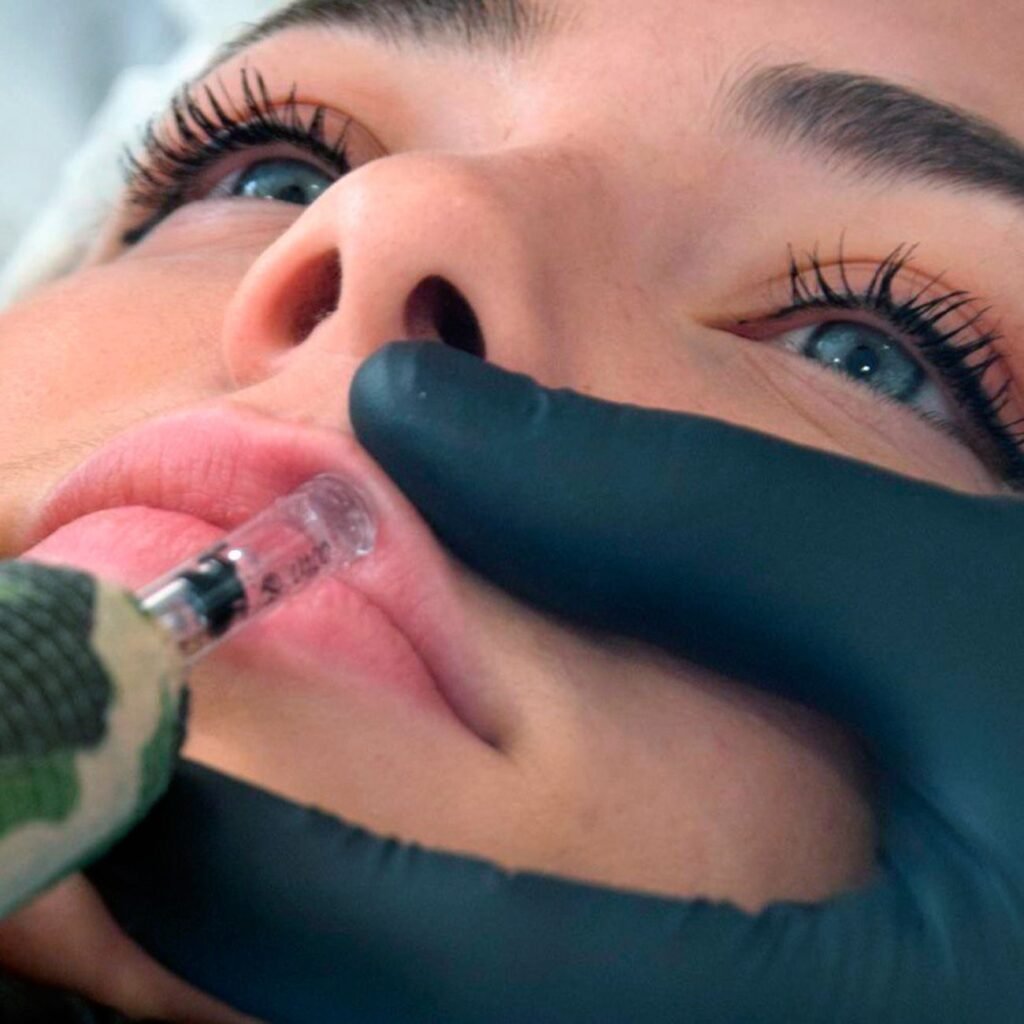 ACIDO-HIALURONICO-LABIOS-HIALUROPEN-PALMA-DE-MALLORCA-CENTROS-MOURE-8