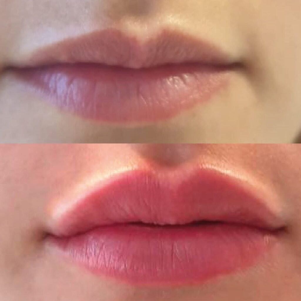 ACIDO-HIALURONICO-LABIOS-HIALUROPEN-PALMA-DE-MALLORCA-CENTROS-MOURE-9