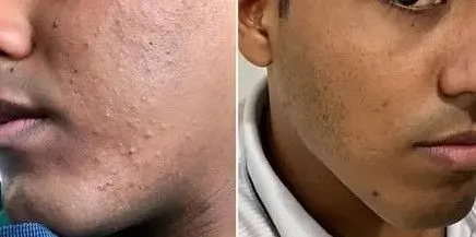 ACNE-EN-LA-CARA-ANTES-Y-DESPUES-10