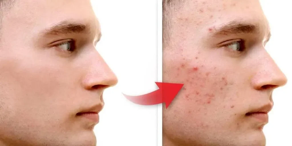 ACNE-EN-LA-CARA-ANTES-Y-DESPUES-11