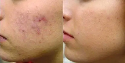 ACNE-EN-LA-CARA-ANTES-Y-DESPUES-12