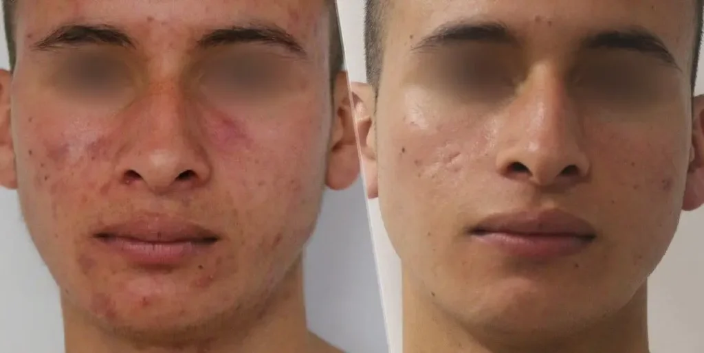 ACNE-EN-LA-CARA-ANTES-Y-DESPUES-13