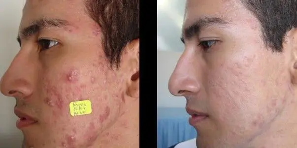 ACNE-EN-LA-CARA-ANTES-Y-DESPUES-14