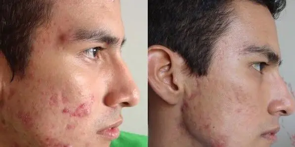 ACNE-EN-LA-CARA-ANTES-Y-DESPUES-15