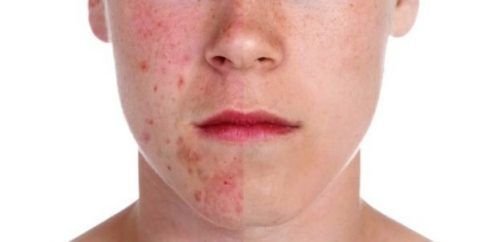 ACNE-EN-LA-CARA-ANTES-Y-DESPUES-16-480x242