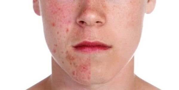 ACNE-EN-LA-CARA-ANTES-Y-DESPUES-16