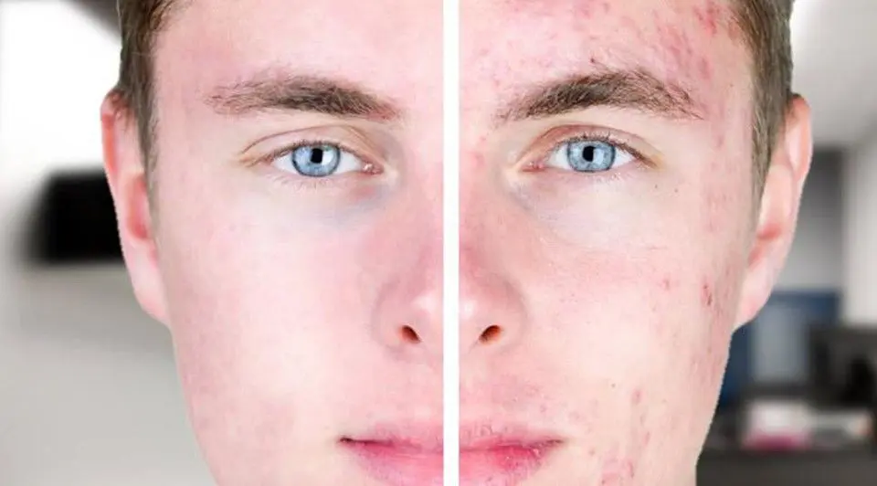 ACNE-EN-LA-CARA-ANTES-Y-DESPUES-17