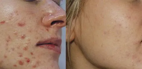 ACNE-EN-LA-CARA-ANTES-Y-DESPUES-18