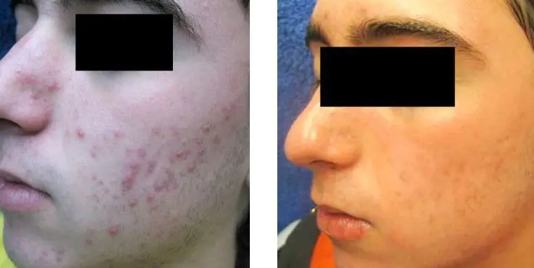 ACNE-EN-LA-CARA-ANTES-Y-DESPUES-20