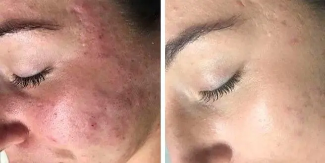 ACNE-EN-LA-CARA-ANTES-Y-DESPUES-21