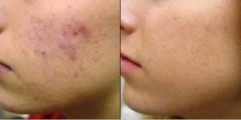 ACNE-EN-LA-CARA-ANTES-Y-DESPUES-23