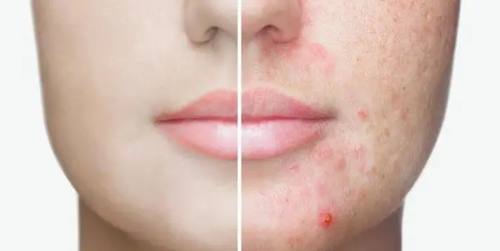 ACNE-EN-LA-CARA-ANTES-Y-DESPUES-25