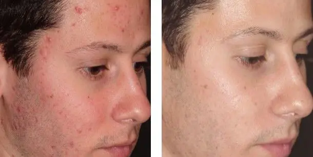 ACNE-EN-LA-CARA-ANTES-Y-DESPUES-3