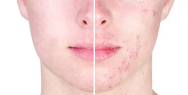 ACNE-EN-LA-CARA-ANTES-Y-DESPUES-4