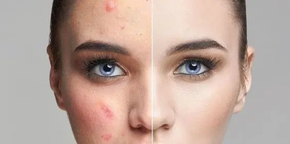 ACNE-EN-LA-CARA-ANTES-Y-DESPUES-6