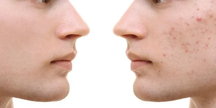 ACNE-EN-LA-CARA-ANTES-Y-DESPUES-7