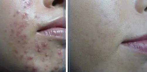 ACNE-EN-LA-CARA-ANTES-Y-DESPUES-8