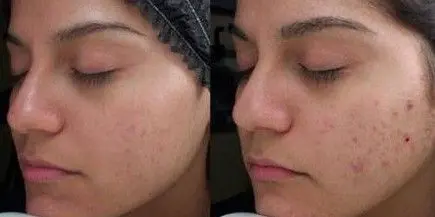 ACNE-EN-LA-CARA-ANTES-Y-DESPUES-9