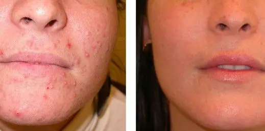 ACNE-EN-LA-CARA-ANTES-Y-DESPUES-CENTROS-MOURE-MALLORCA-19