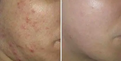 ACNE-EN-LA-CARA-ANTES-Y-DESPUES-CENTROS-MOURE-MALLORCA-2