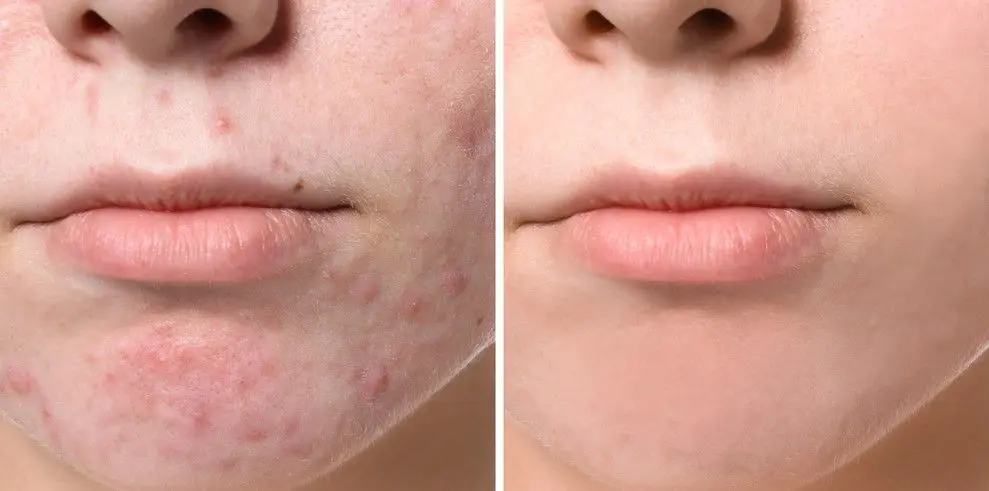ACNE-EN-LA-CARA-ANTES-Y-DESPUES-CENTROS-MOURE-MALLORCA-22