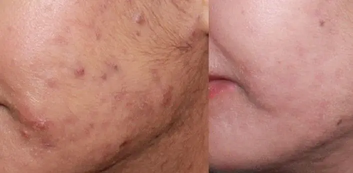 ACNE-EN-LA-CARA-ANTES-Y-DESPUES-CENTROS-MOURE-MALLORCA-5
