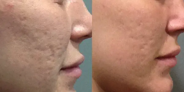 ACNE-EN-LA-CARA-ANTES-Y-DESPUES-MARCAS-DE-ACNE