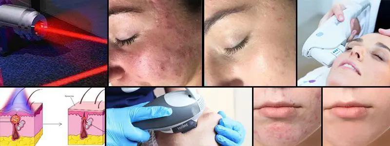 BANNER-TRATAMIENTO-LASER-PARA-EL-ACNE-CENTROS-DE-ESTETICA-MOURE-PALMA-DE-MALLORCA-1