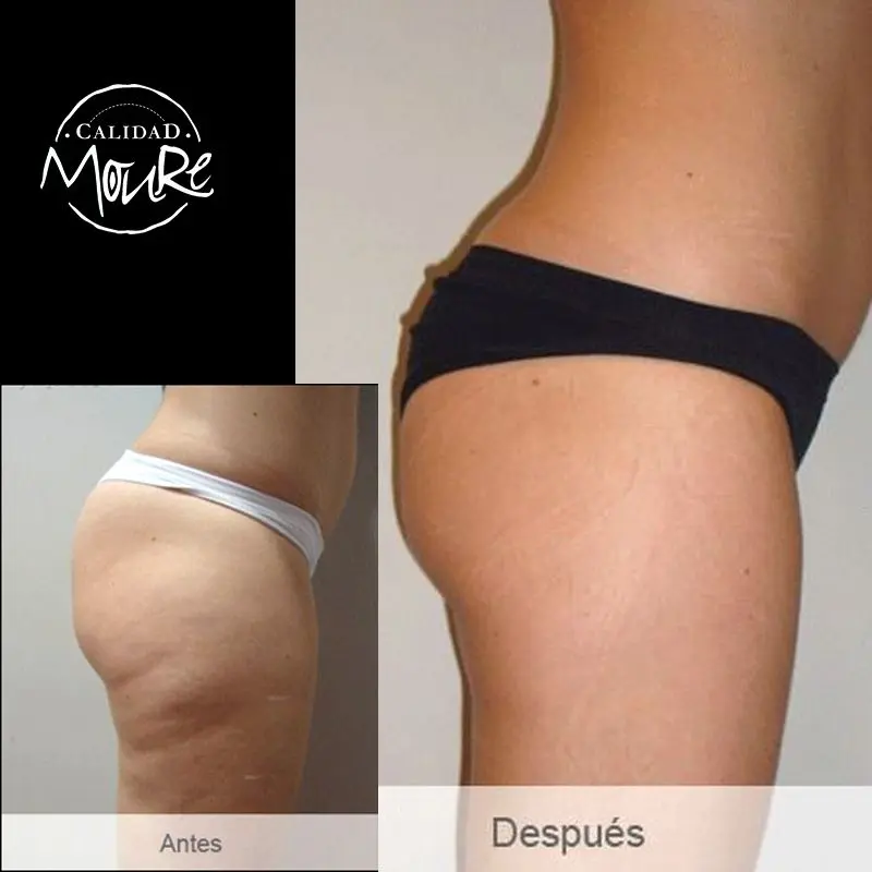 FOTOS-DE-ANTES-Y-DESPUES-DE-TRATAMIENTO-DE-REAFIRMACION-DE-GLUTEOS-1