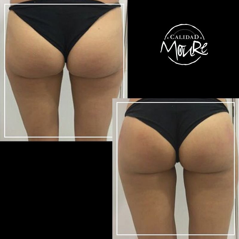 FOTOS-DE-ANTES-Y-DESPUES-DE-TRATAMIENTO-DE-REAFIRMACION-DE-GLUTEOS-2