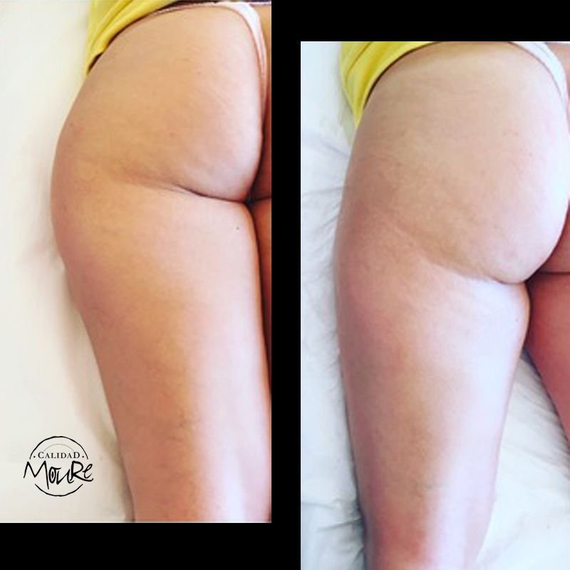 FOTOS-DE-ANTES-Y-DESPUES-DE-TRATAMIENTO-DE-REAFIRMACION-DE-GLUTEOS-3