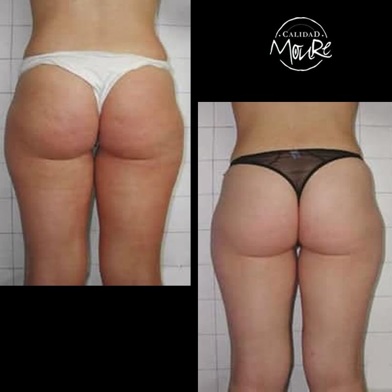 FOTOS-DE-ANTES-Y-DESPUES-DE-TRATAMIENTO-DE-REAFIRMACION-DE-GLUTEOS-4