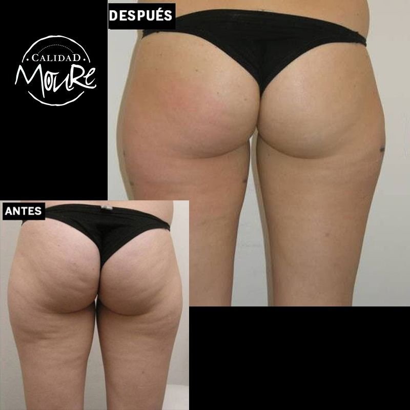 FOTOS-DE-ANTES-Y-DESPUES-DE-TRATAMIENTO-DE-REAFIRMACION-DE-GLUTEOS-6
