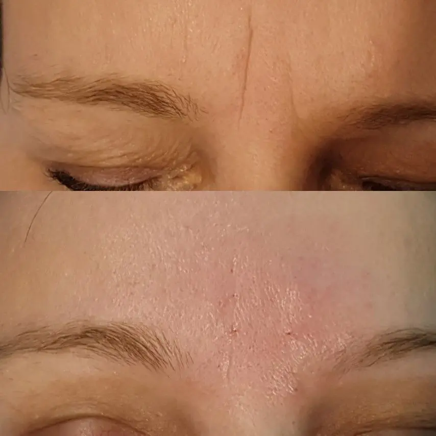 HIALUROPEN-HACIDO-HIALURONICO-ENTRECEJO-Y-NASOGENIANOMALLORCA-ESTETICA-MOURE-4