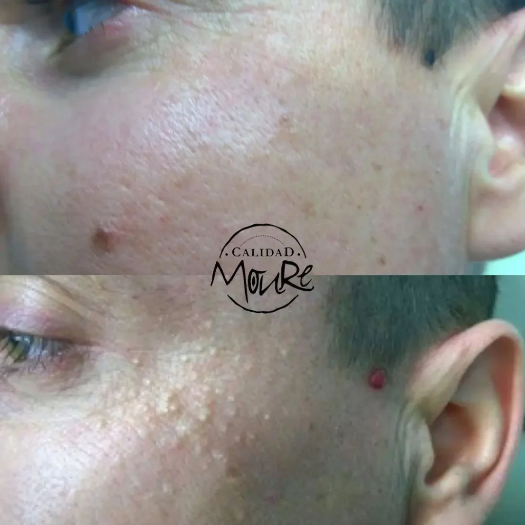 LIMPIEZA-DE-CUTIS-ELIMINACION-DE-MILIUNS-1
