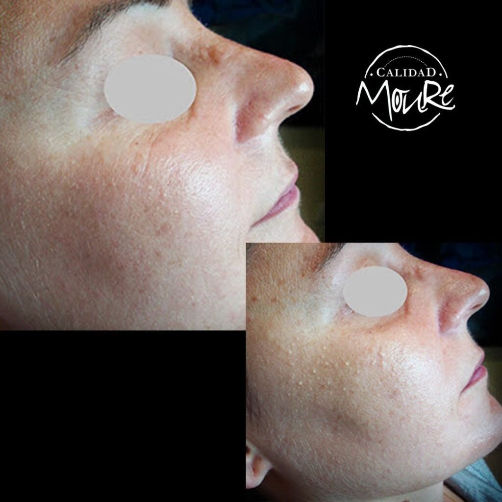 LIMPIEZA-DE-CUTIS-ELIMINACION-DE-MILIUNS-2