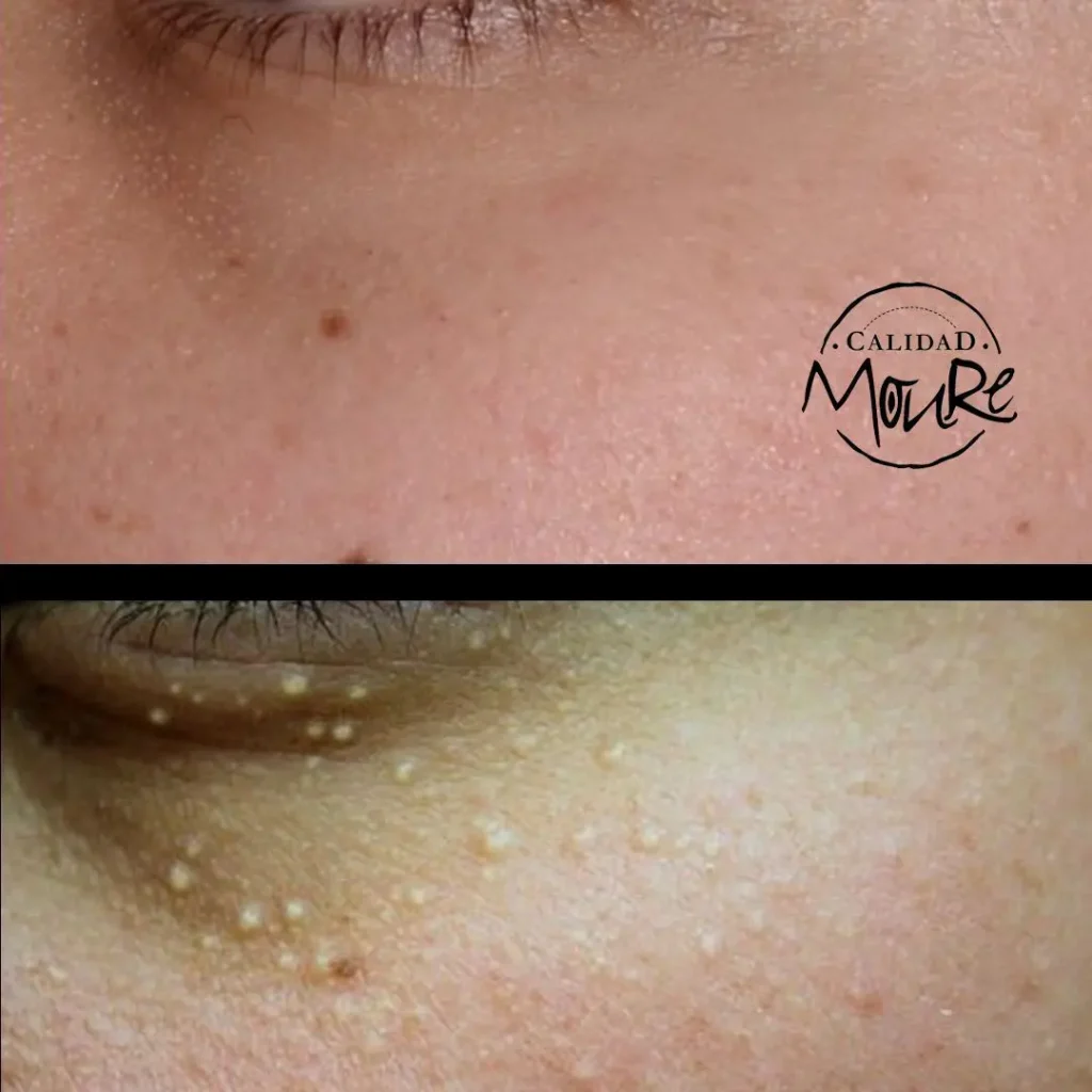 LIMPIEZA-DE-CUTIS-ELIMINACION-DE-MILIUNS-3
