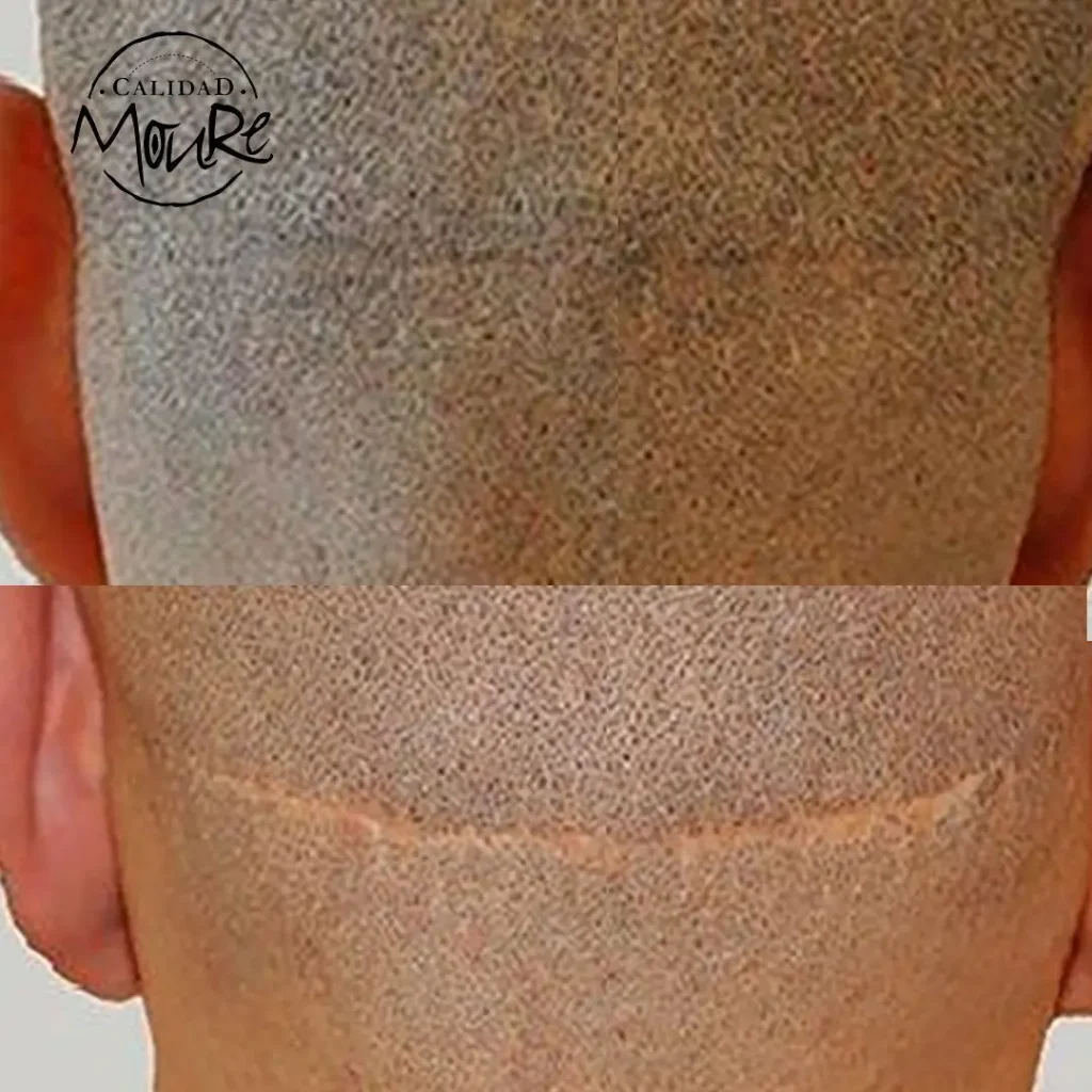MICROPIGMENTACION-CAPILAR-CICATRICES-MOURE-1-1