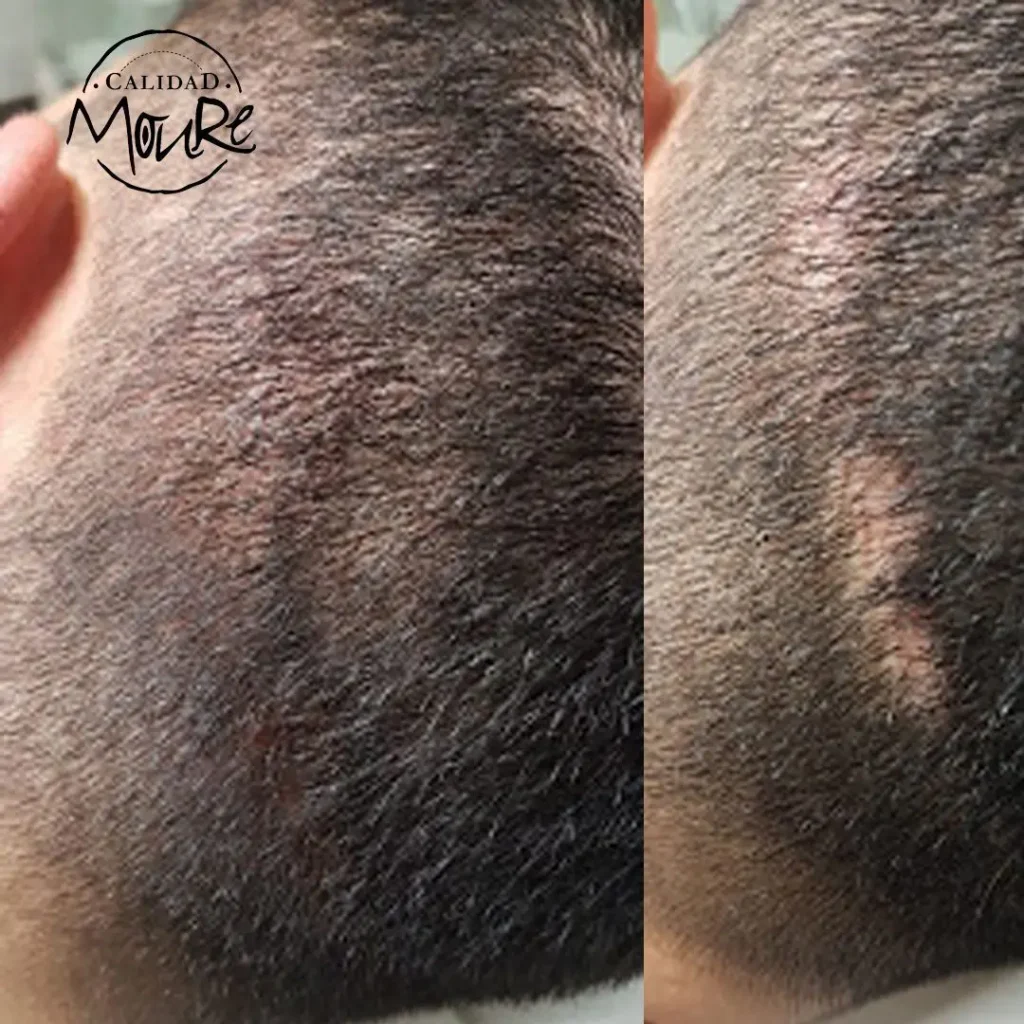MICROPIGMENTACION-CAPILAR-CICATRICES-MOURE-3-1