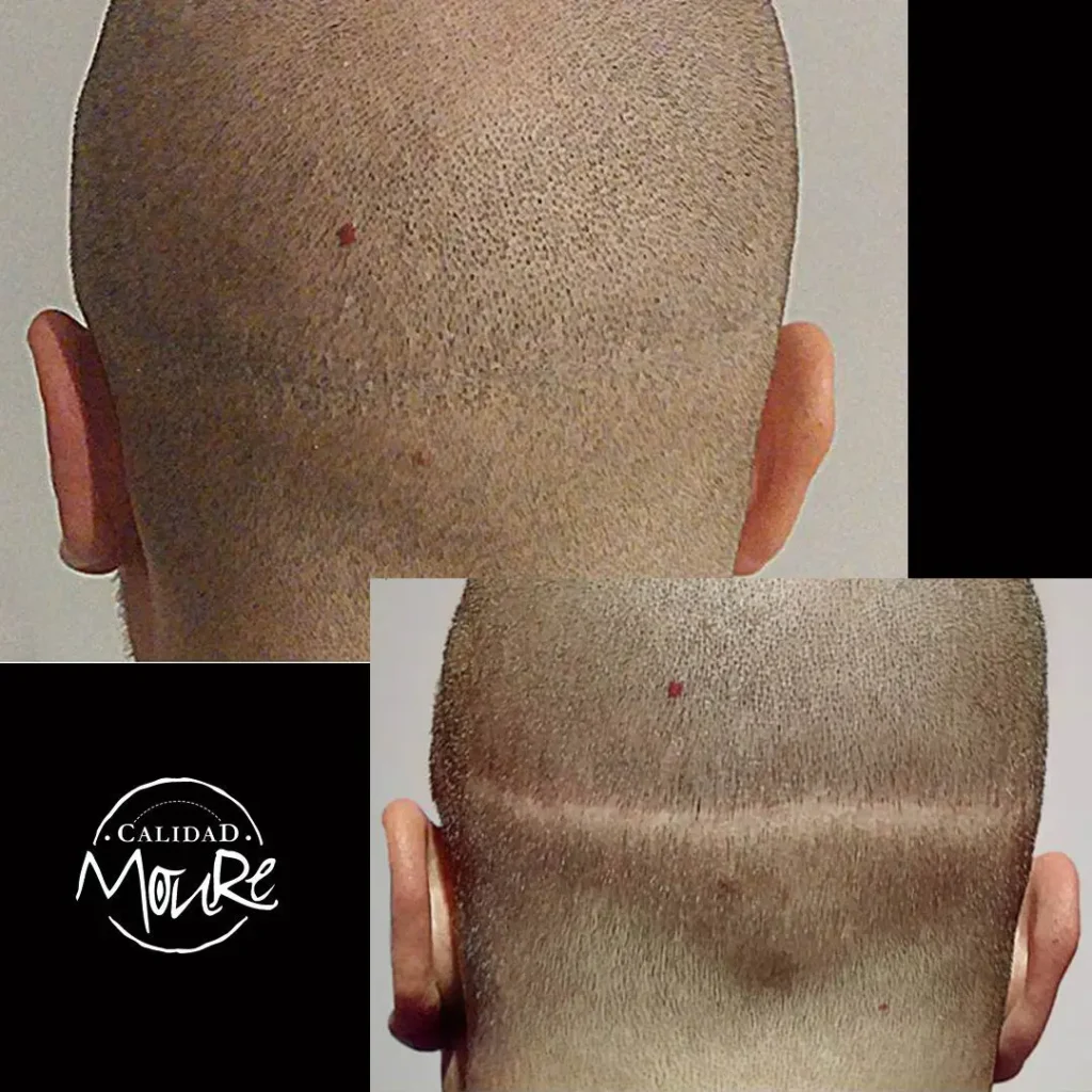 MICROPIGMENTACION-CAPILAR-CICATRICES-MOURE-4-1