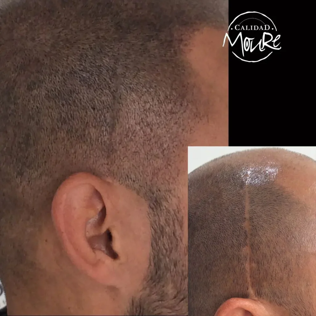 MICROPIGMENTACION-CAPILAR-CICATRICES-MOURE-5-1